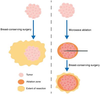 Precision Breast-Conserving Surgery With Microwave Ablation Guidance: A Pilot Single-Center, Prospective Cohort Study